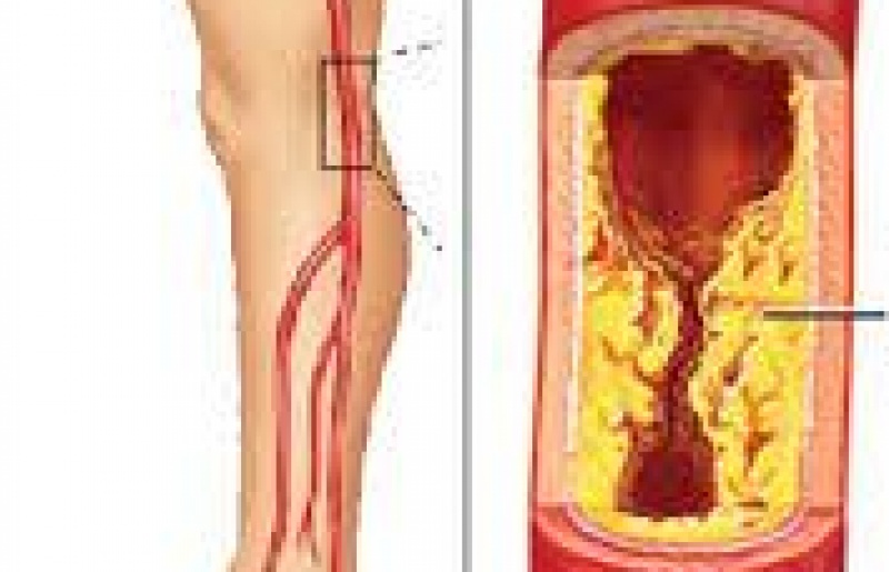 Tế bào gốc thần kinh – Giải pháp cho thiếu máu cục bộ